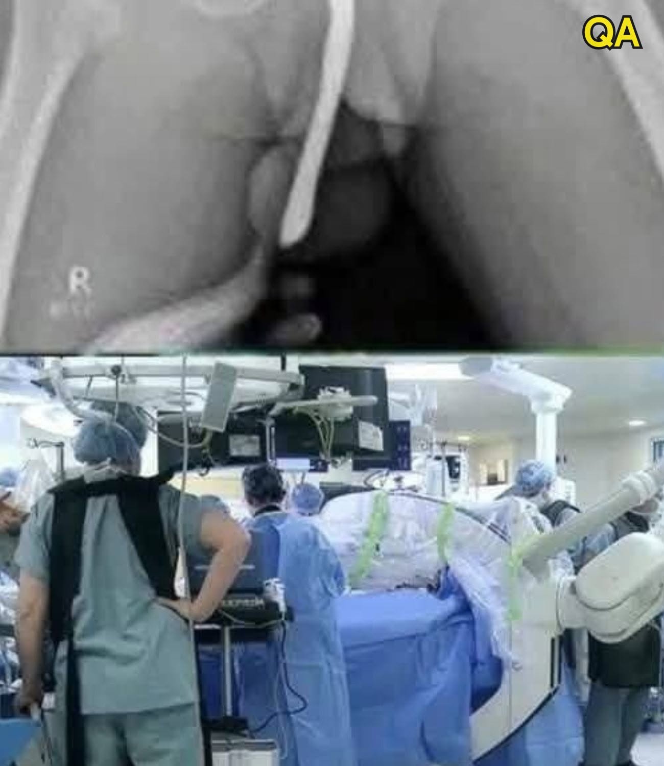 Nouvelles HT14. Une jeune fille a dû être hospitalisée pour avoir voulu utiliser un…Voir plus