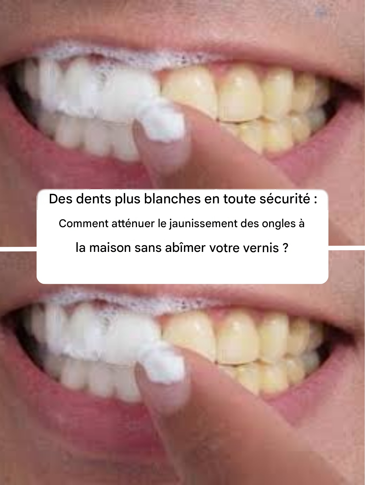 Blanchir ses dents en toute sécurité : comment atténuer le jaunissement des dents à la maison sans abîmer l’émail